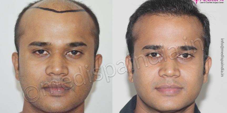 top hair transplant clinics in usa