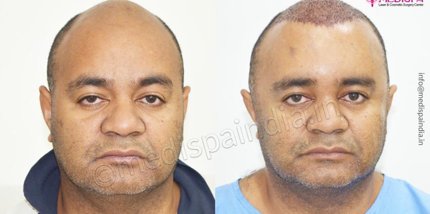 hair restoration australia