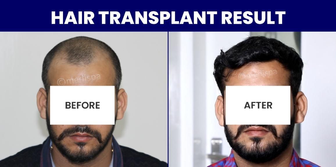 Say Goodbye To Hair Loss Issue With Hair Restoration