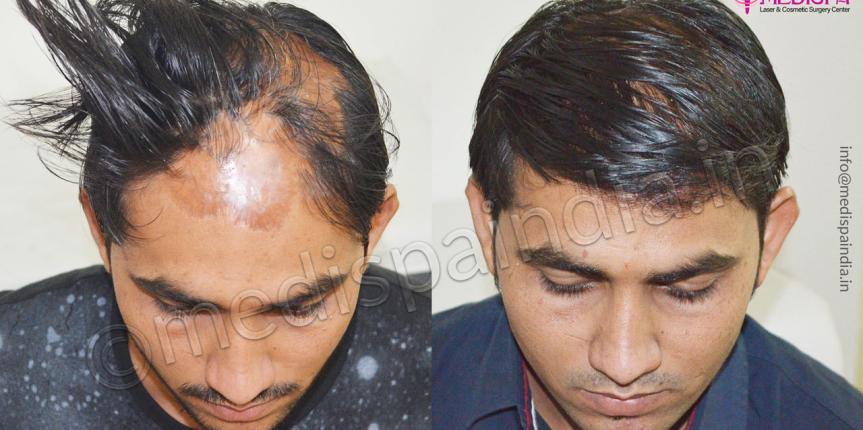 burn hair transplant correction medispa