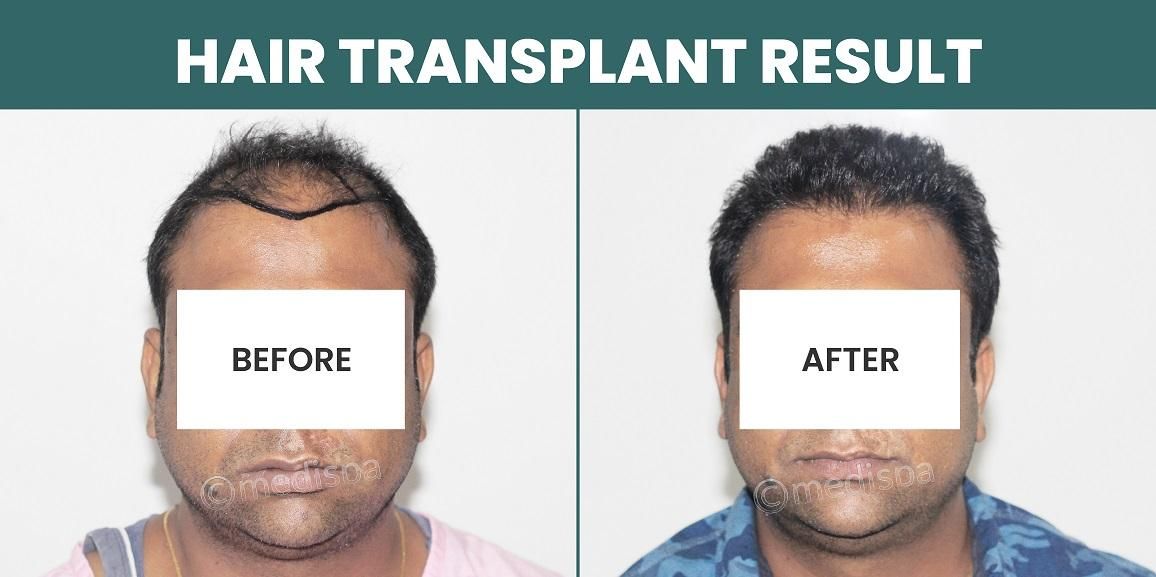 Best Hair Restoration Method For High Grade Baldness