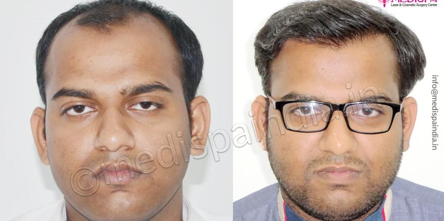hair transplant in jaipur rajasthan