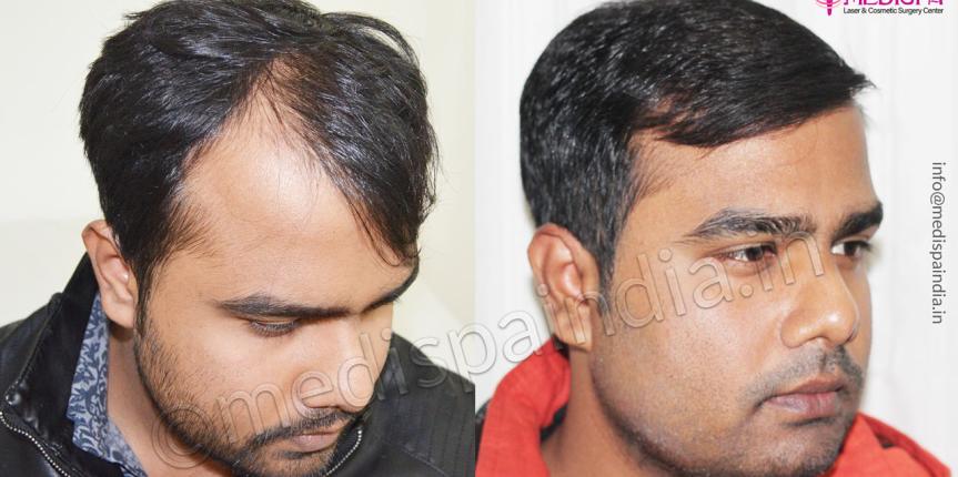 hair transplant cost in chennai