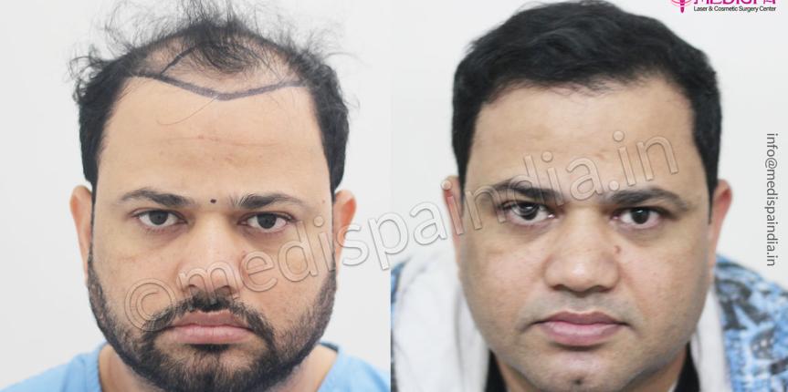 hair transplant in hyderabad
