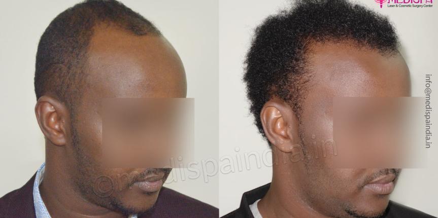 africans hair transplant