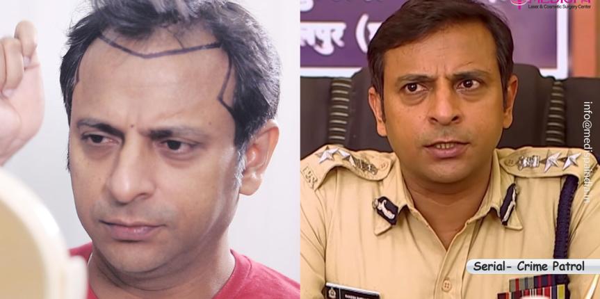 celebrity before after hair transplant