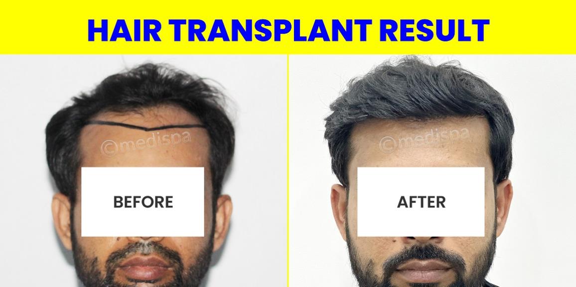 Importance Of Graft Survival Rate In Hair Restoration