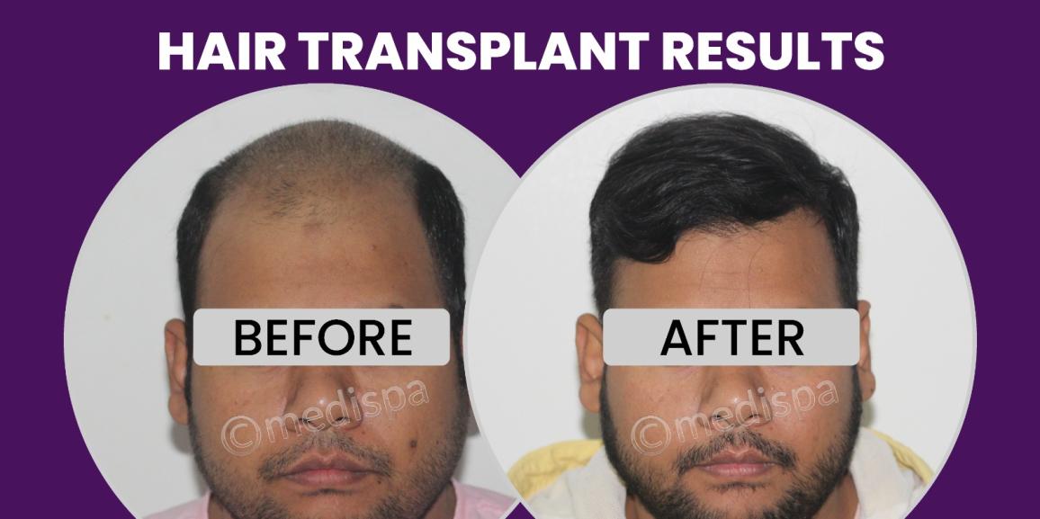 Precautions To Be Taken Before And After Hair Transplant