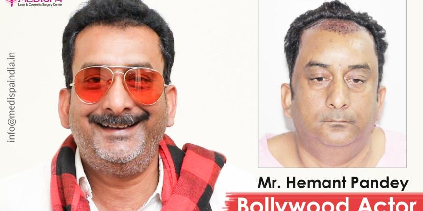 bollywood actor hemant pandey hair transplant