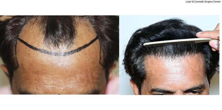hair transplant