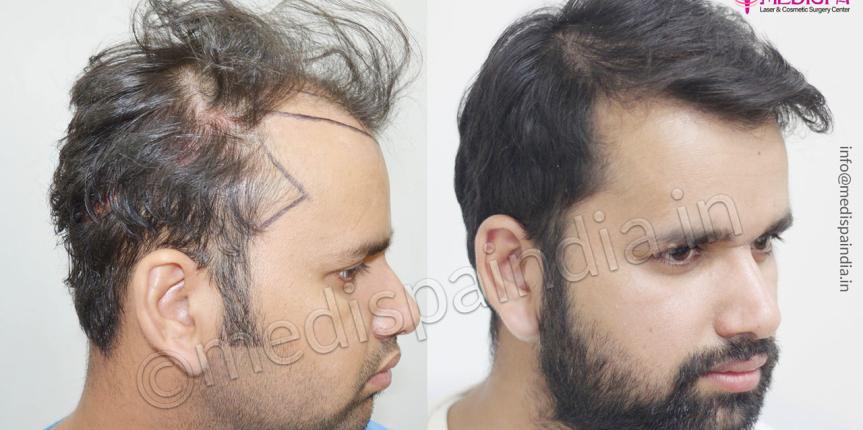 hair transplant cost in sydney