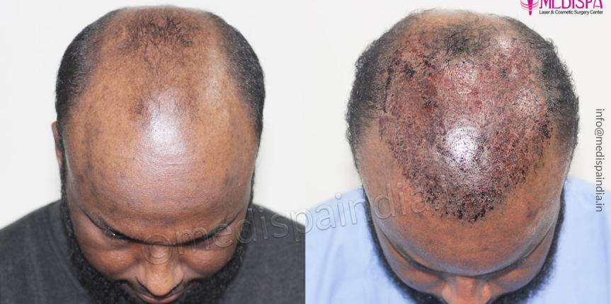 hair transplant before after sweden