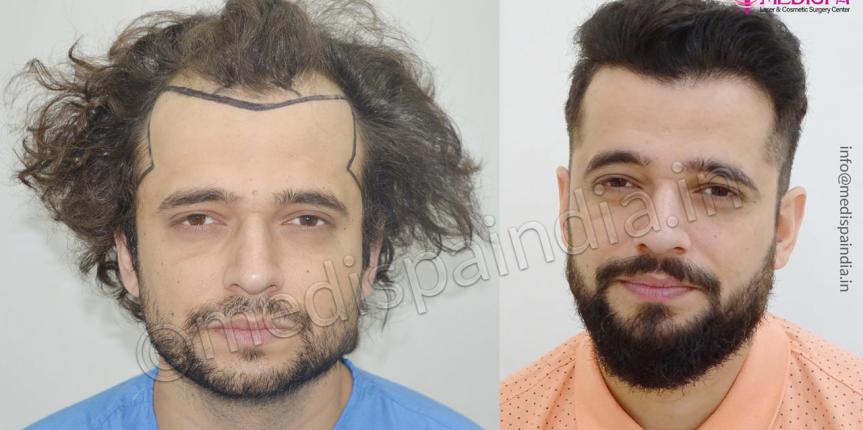 hair transplant usa results