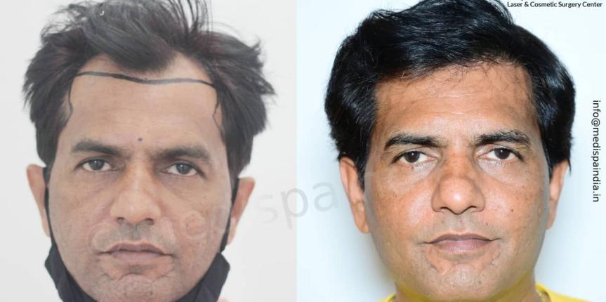 hair transplant cost