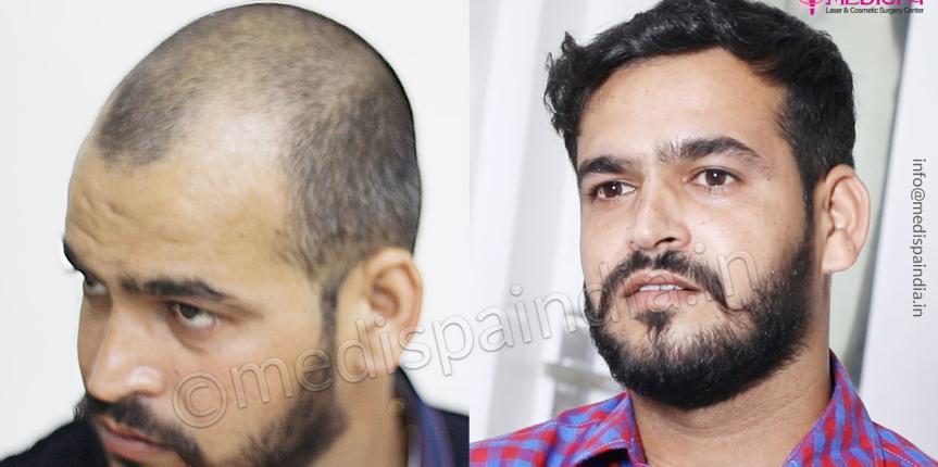 hair restoration after before jaipur