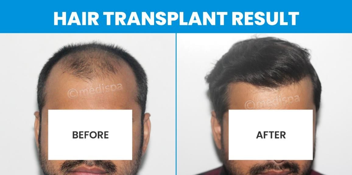 Understanding The Requirements Of Hair Transplant Surgery