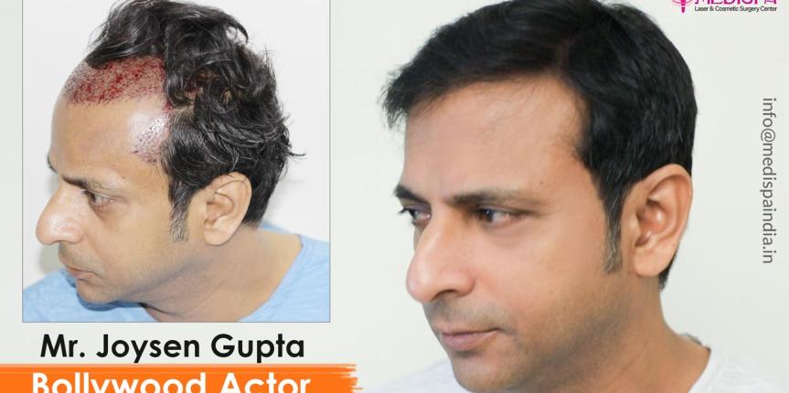 bollywood actor joysen gupta hair transplant india