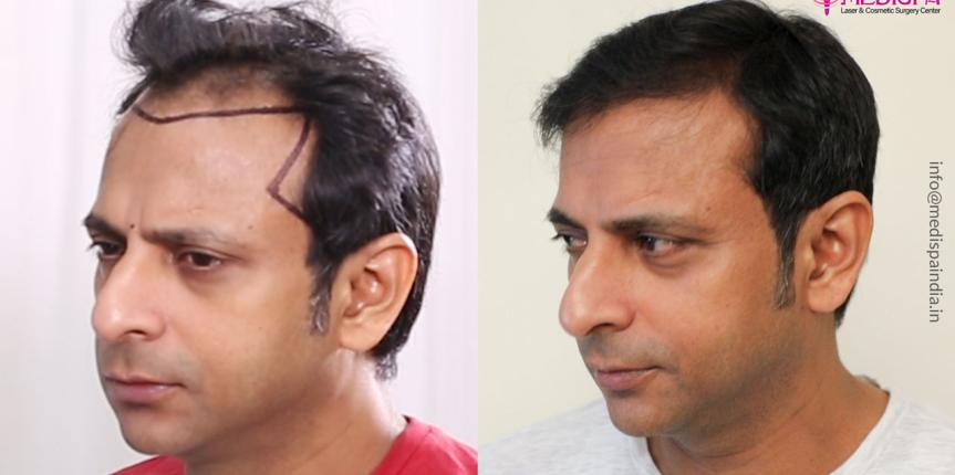hair transplant before after celebrity