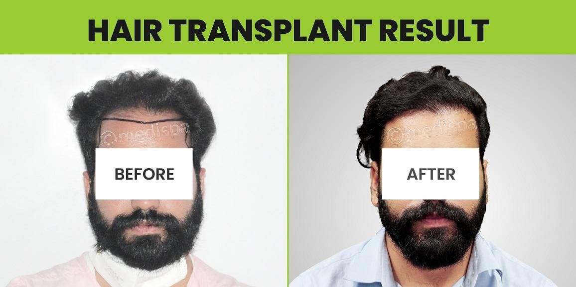 What Are The Key Indicators Of A Successful Hair Transplant?