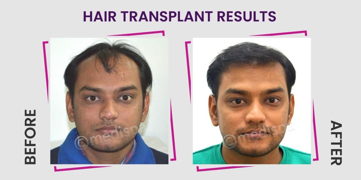 Things To Consider Before Choosing The Best Hair Transplant Clinic