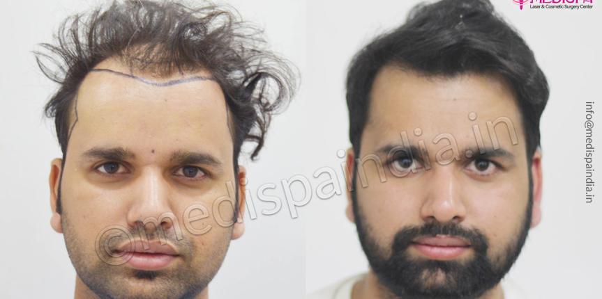 hair transplant in sydney australia
