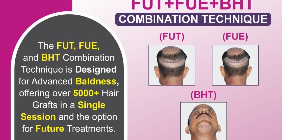 FUT+FUE+BHT Combined Hair Transplant Vs Other Methods