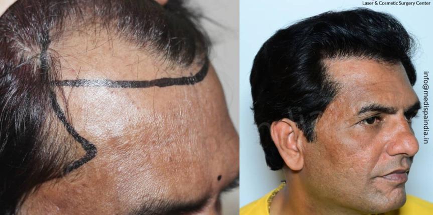 hair transplant doctor