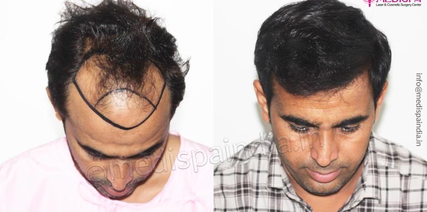 best hair transplant results in jaipur