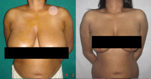 Breast Reduction, Top Hair Transplant Center Delhi, Jaipur