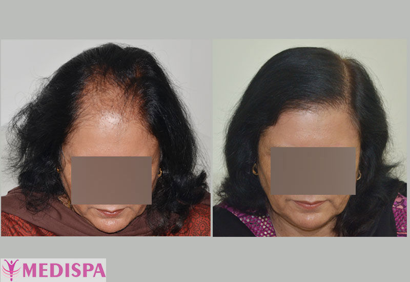 Female Hair Transplant in Hyderabad  View Cost  ReDefine Clinic