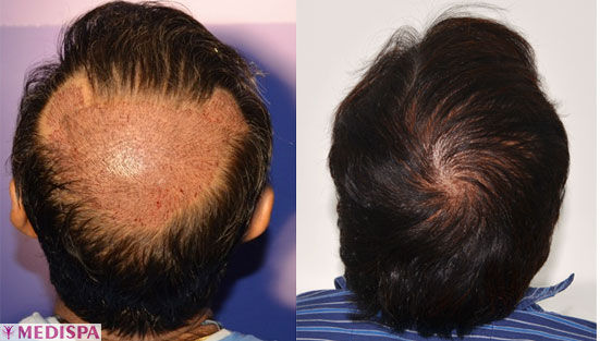 Female hair thinning at the crown and how to deal with it effectively in  Singapore  Bee Choo Ladies