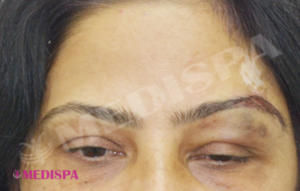 eyebrow hair transplant