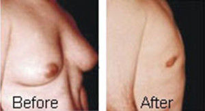 Best Gynecomastia Delhi, Male Breast Reduction Surgery India