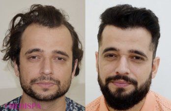 Top 5 Best Hair Transplant In Turkey And The Cost List 2023  The Tribune  India