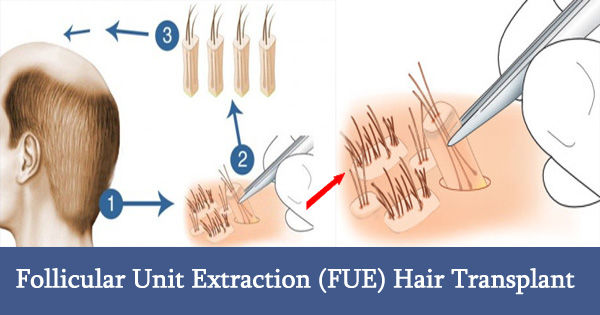 Pre and Post-Operative Instructions for FUE Hair Transplants