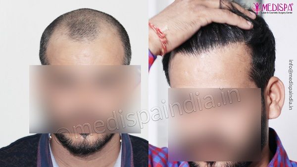 Hair Transplant in Jaipur