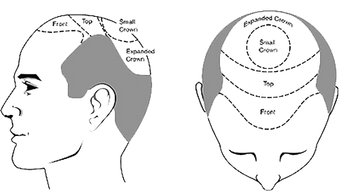 Hair Transplant cost In Delhi | Hair Transplant cost in India Hair Transplant cost In Delhi | Hair Transplant cost in India