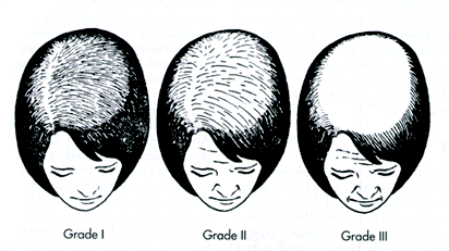 Female Pattern Baldness : Causes, Treatments, Hair Loss Female Pattern Baldness : Causes, Treatments, Hair Loss