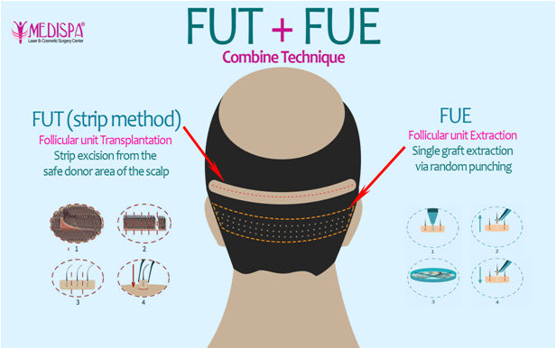 10 Reasons to Choose FUE Hair Transplant Treatment  ALCS  Cosmetic  Surgery  Hair Transplant In Jaipur