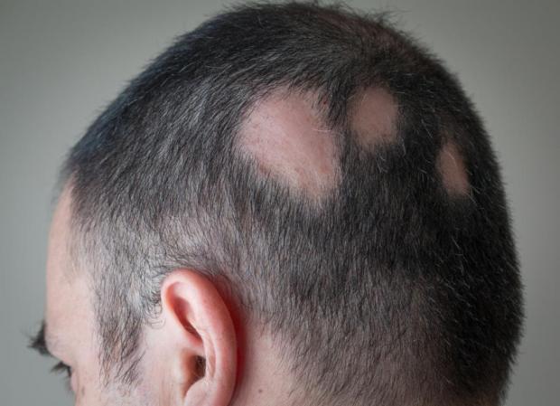 Pin By Kadirbutun On Erkek Sac Dokulmesi Help Hair Loss Hair Loss Medication Regrow Hair