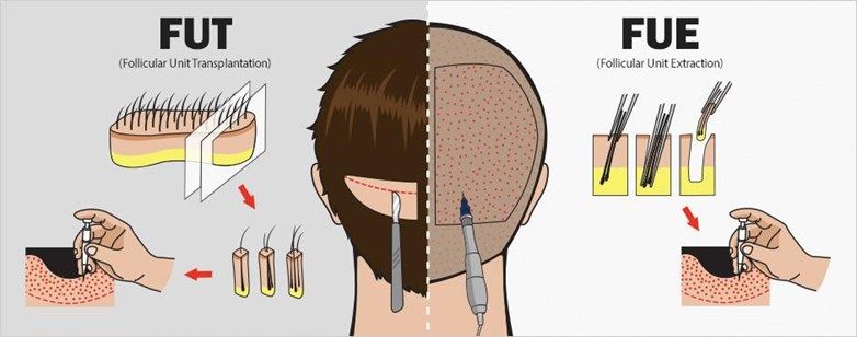 Hair Transplant in Nigeria | Hair Transplant Cost Nigeria Hair Transplant in Nigeria | Hair Transplant Cost Nigeria