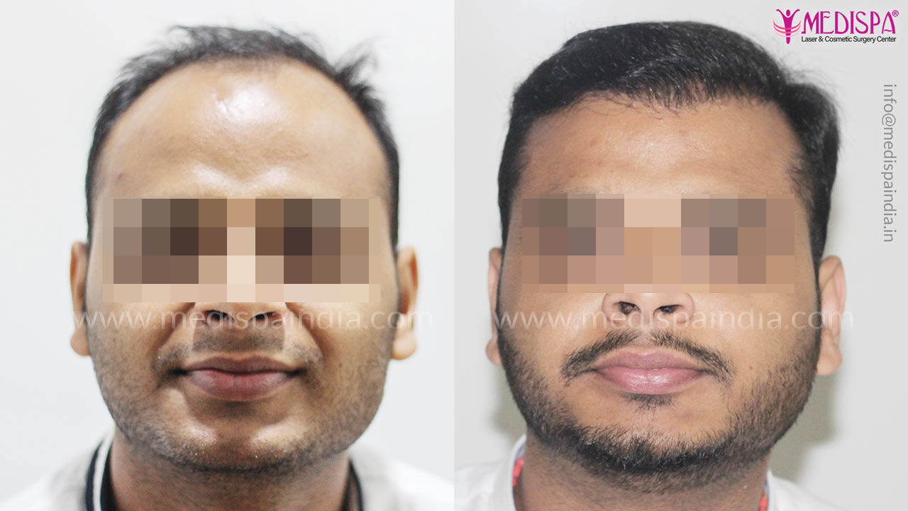 Hair Transplant in Delhi  Call on 919643262600