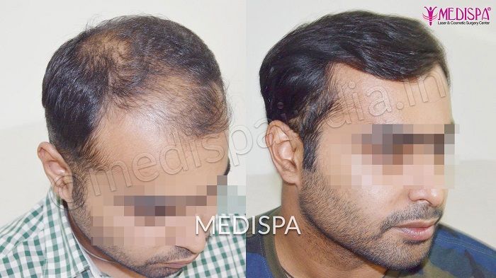 Genetic Hair loss Male pattern BaldnessToppikMalaysia