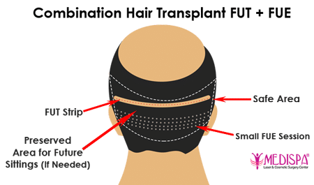 Combination-FUTFUE-hair-transplant