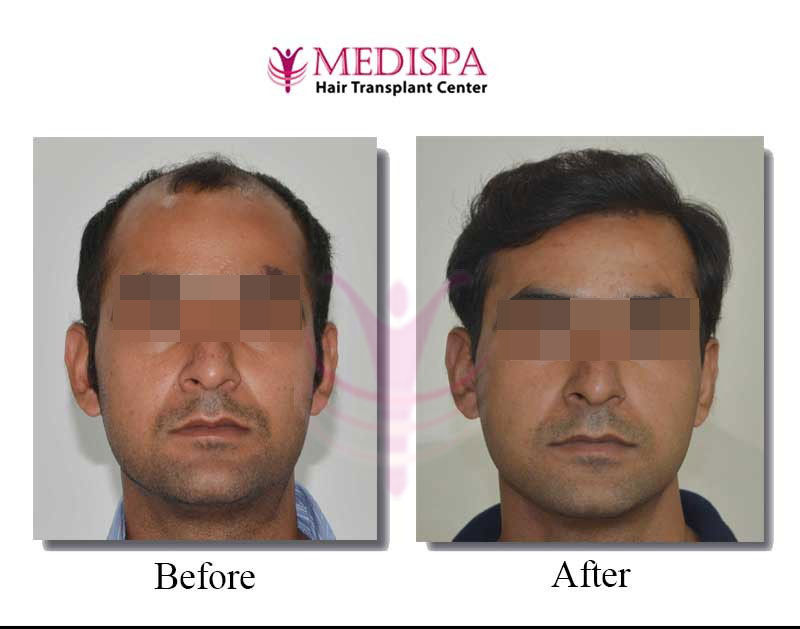 What is Better: FUT or FUE? Know the Difference | Medispa India What is Better: FUT or FUE? Know the Difference | Medispa India