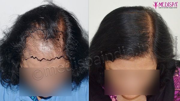 Female Hair Transplant Photo Gallery  Female Hair Transplant Results   Medispa India