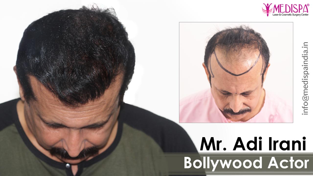 Bollywood Actor, Adi Irani Hair Transplant Results - Medispa Bollywood Actor, Adi Irani Hair Transplant Results - Medispa