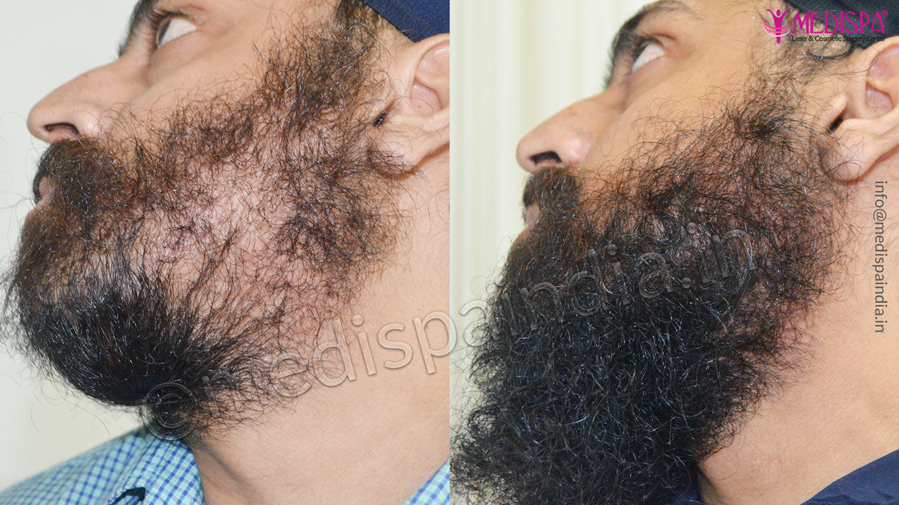 Beard Transplant Cost in India