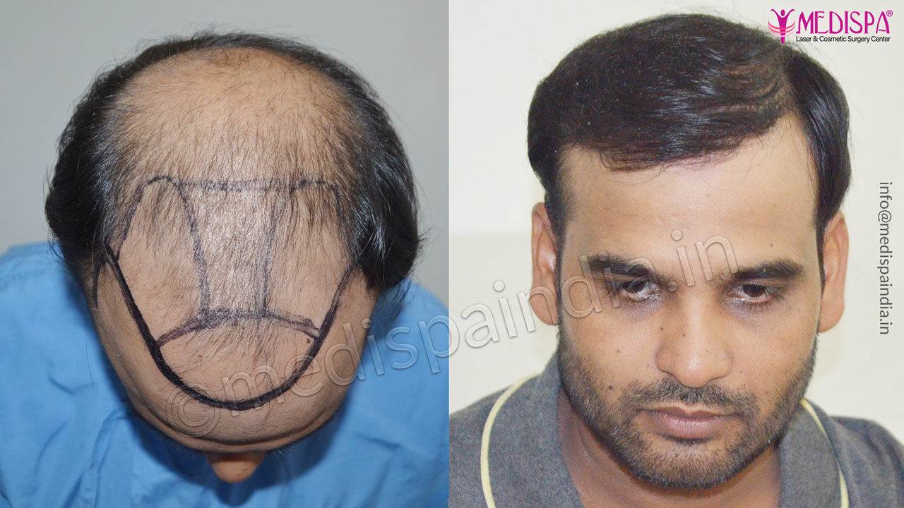 What is the Cost or Price of Hair Transplant in Ahmedabad 