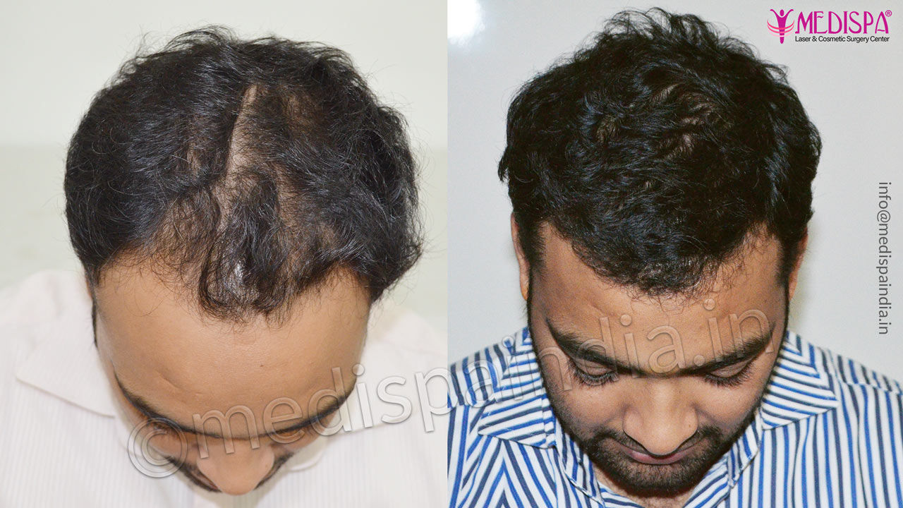 Before and After Hair Restoration Photos - Medispa India Before and After Hair Restoration Photos - Medispa India